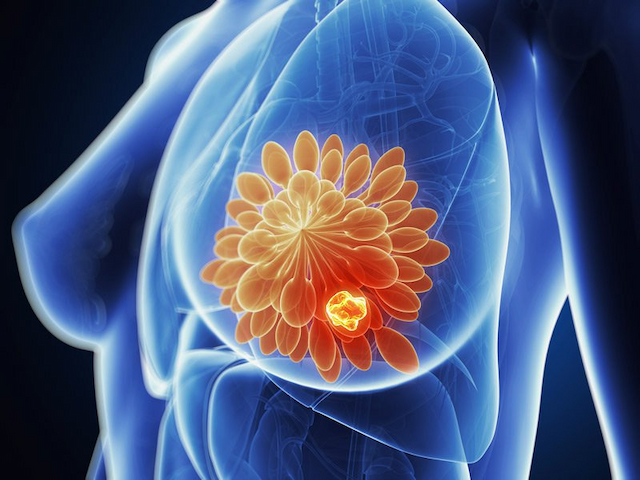 Breast Imaging and Reporting Data System